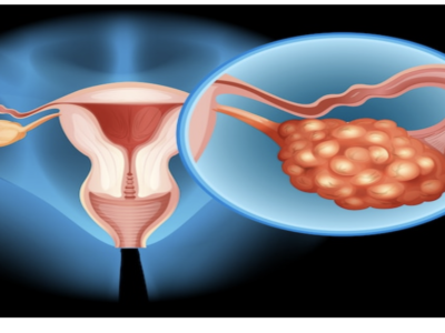 PCOS – Polycystic  Ovary Syndrome